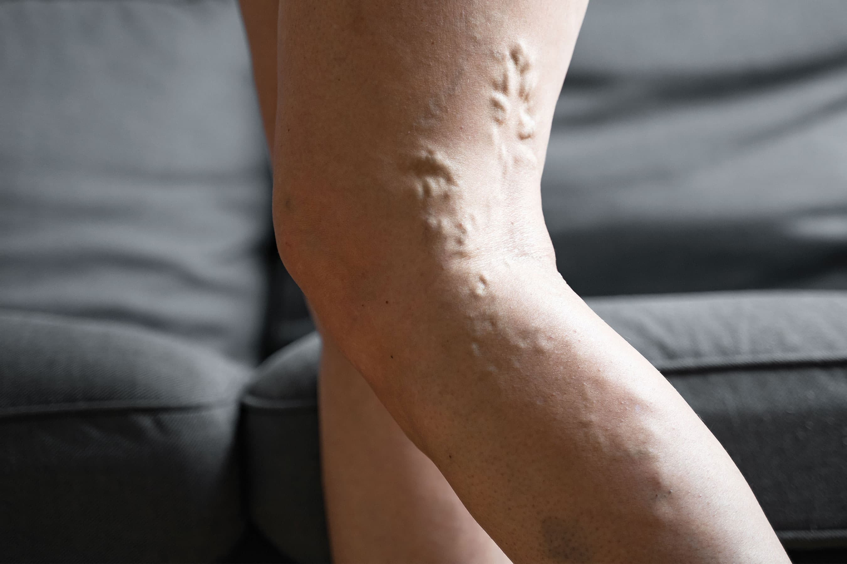 Close-up of a leg with visible varicose veins.